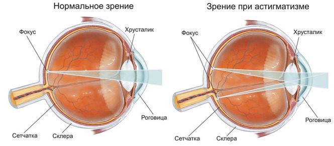 Как различается нормальное зрение и зрение при астигматизме